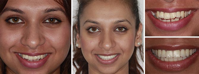 Gurpreet upper and lower clear fixed brace after whitening