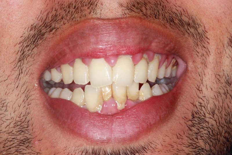 Kent dentist before teeth whitening