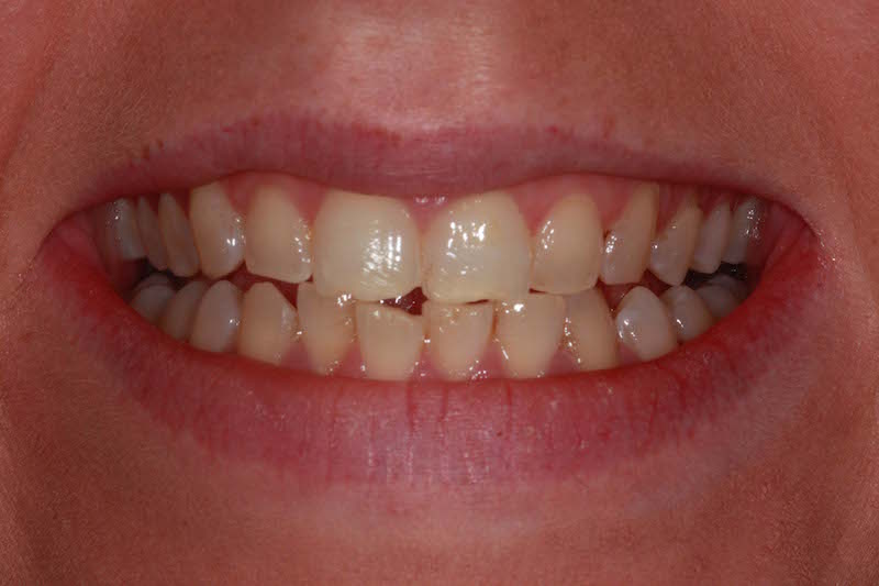 teeth whitening kent before