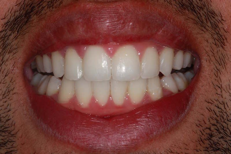 Kent dentist after teeth whitening