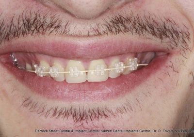 Clear fixed braces