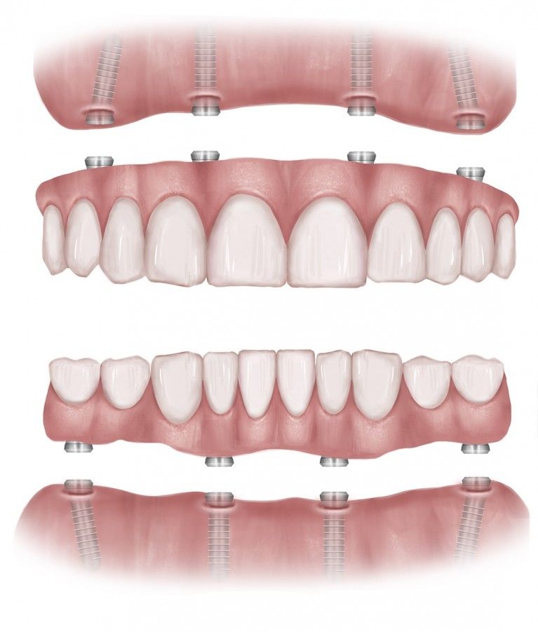 All On 4 Dental Implants Treatment Kent