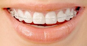 clear-fixed-braces