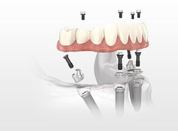 Dental Implants All-on-4