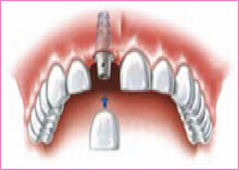 Tooth Implant Gravesend Kent