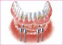 Teeth Implants Gravesend Kent