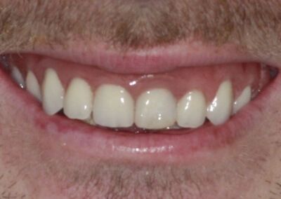 After All on 4 dental implants Gravesend Dentist