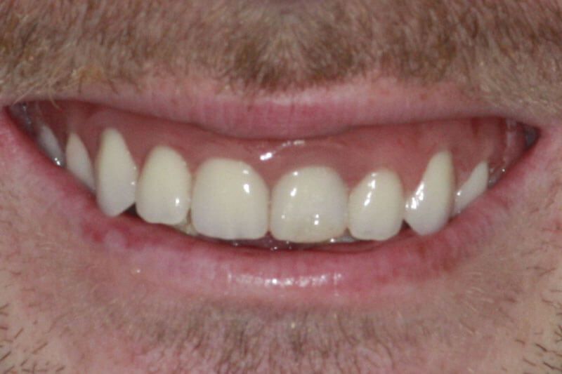 After All on 4 dental implants Gravesend Dentist