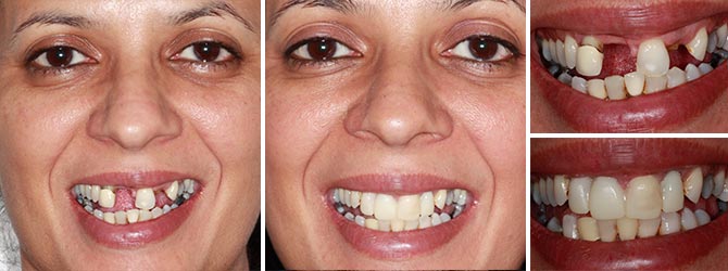 Replace missing front teeth with Dental Implants