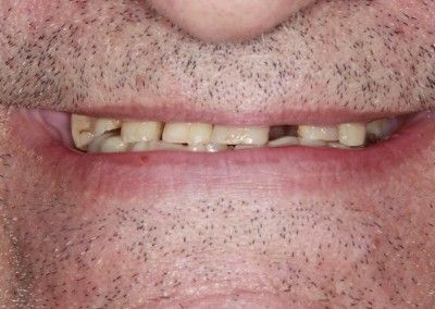 Before All on 4 dental implants kent