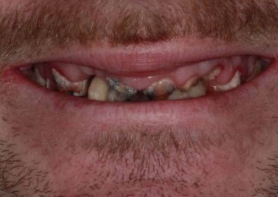 Before dental implants Gravesend Dentist
