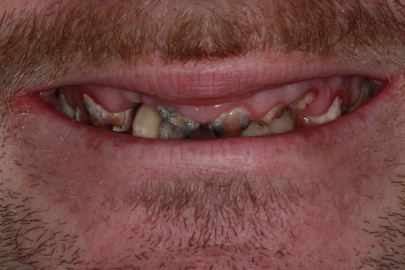 Before dental implants Gravesend Dentist