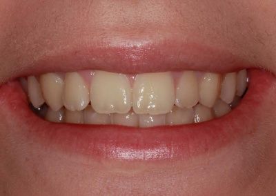 Crooked & Crowded Bottom Teeth Bottom Braces Before & After