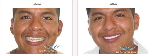 Six month smile before and after case 11 Kent