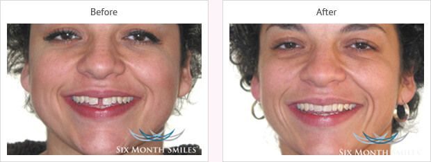 Six month smile before and after case 12
