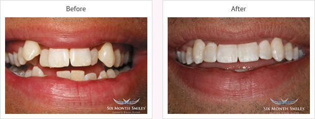 Six month smile before and after case 13