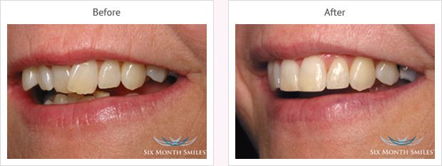 Six month smile before and after case 14 Kent