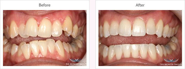 Six month smile before and after case 15