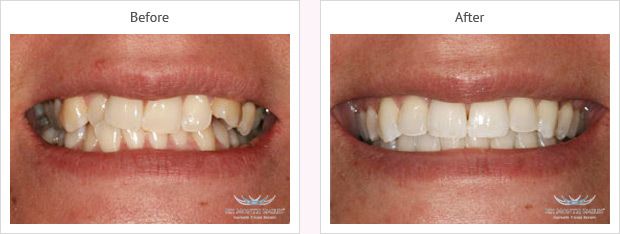 Six month smile before and after case 4 Kent