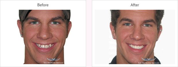 Six month smile before and after case 7