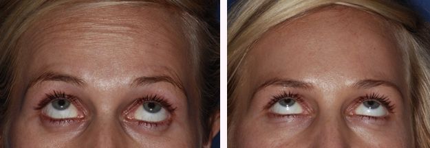 Botox Forehead before after by Kent Dentists