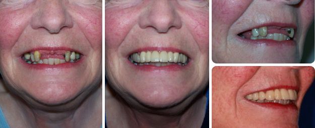 Replacement of her upper partial denture with fixed teeth