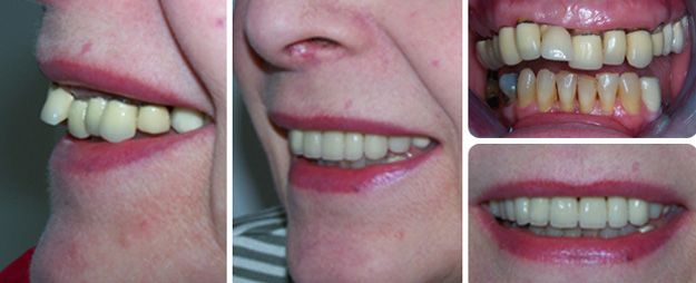 Crowns in wrong position which are discoloured and leaking