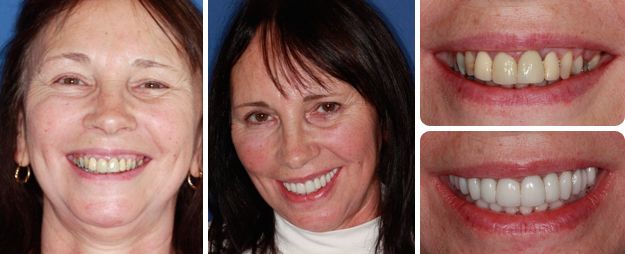 Improve the colour, position and overall shape of her teeth and gums – Sue