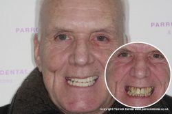 Raymond – Replaced full set of teeth