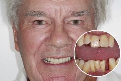 Alan – Replaced full set of teeth