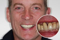 Martin – Replaced multiple teeth