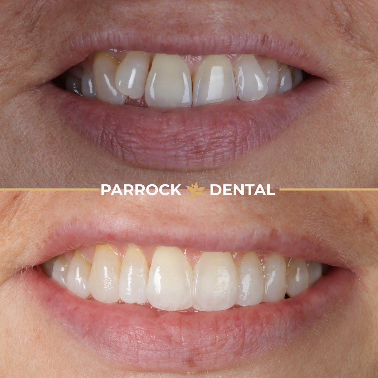 Rebecca Greenwood - Invisalign - 2