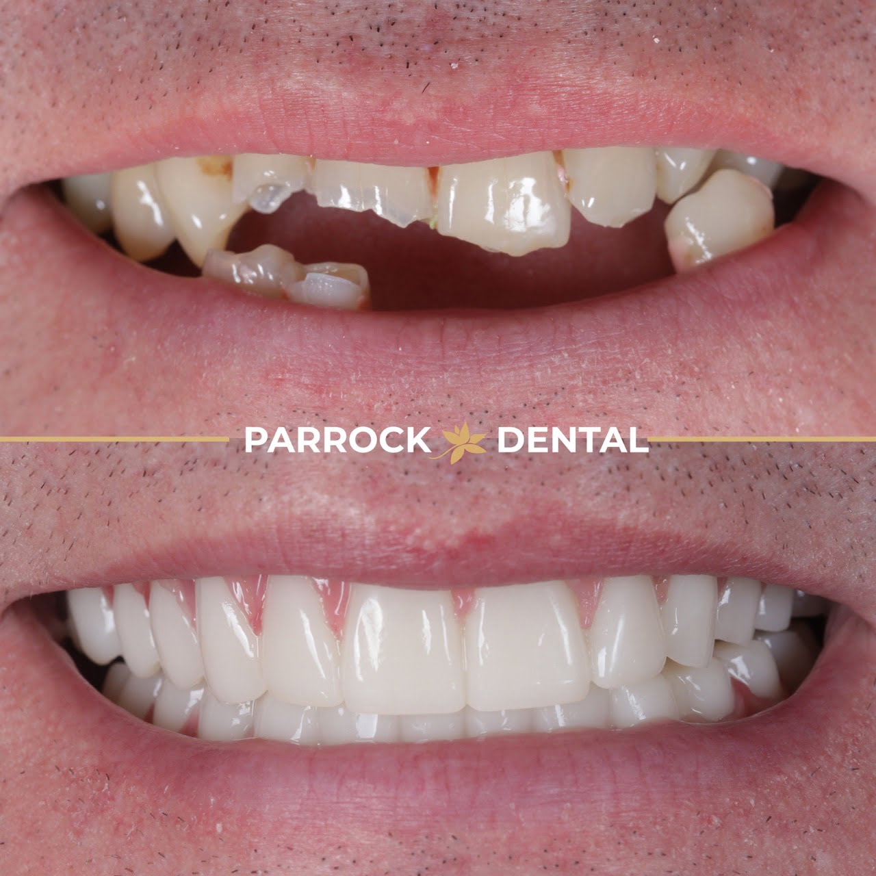 mike martin-dental implants - 2