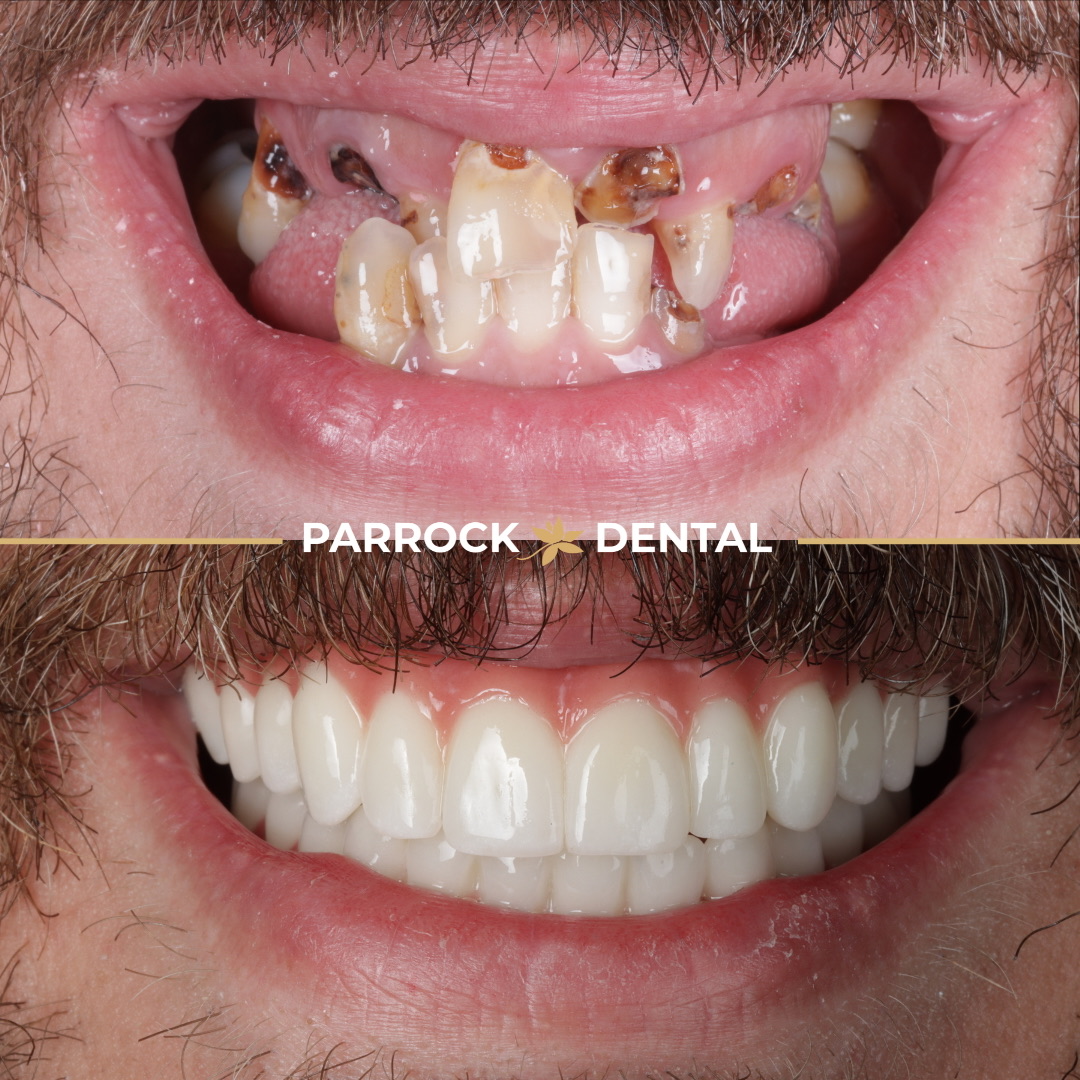 Stuart Cable - ao4 Upper & Lower Dental Implants - 3