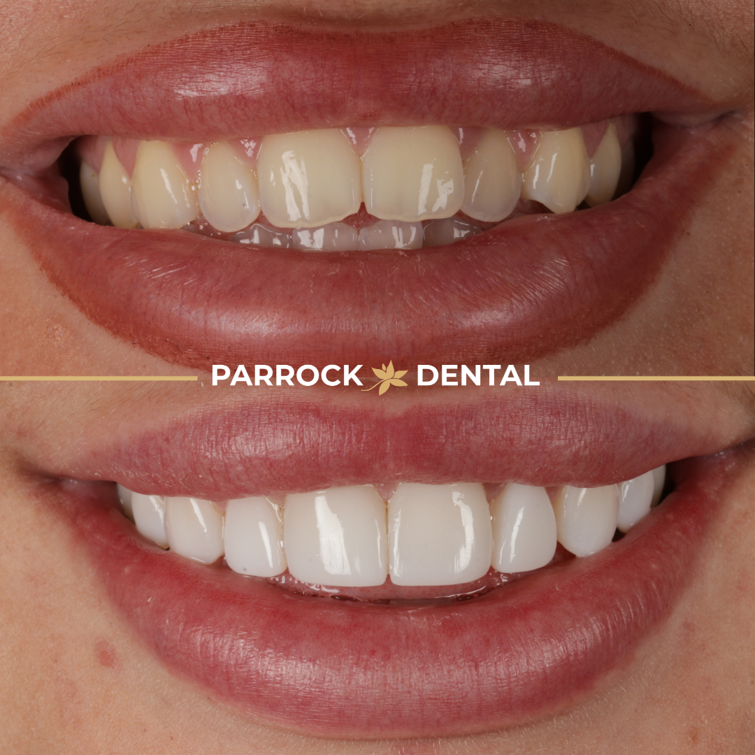 Emma Rhodes - Composite Veneers before after