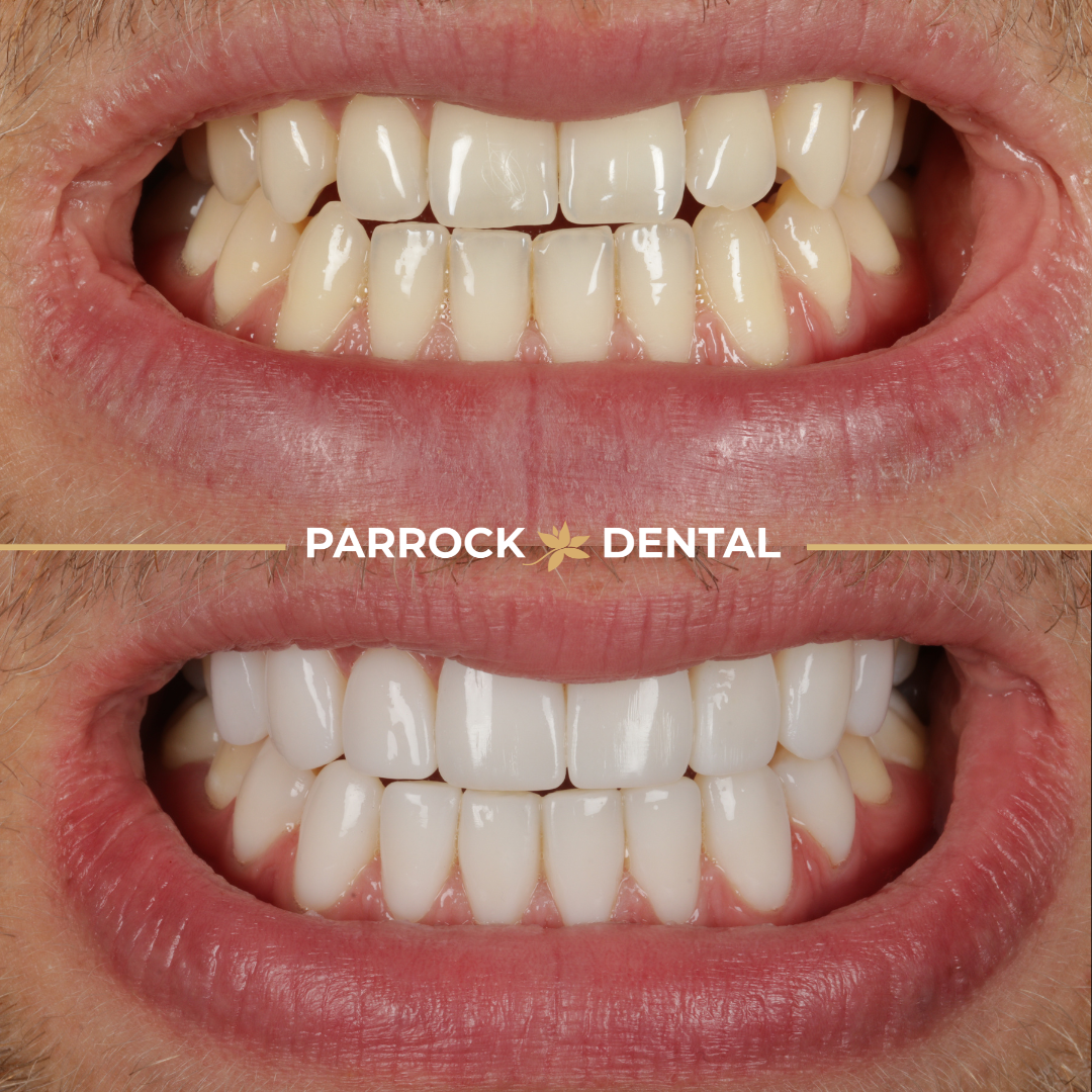 Taylor Berry - Composite Veneers-before-after