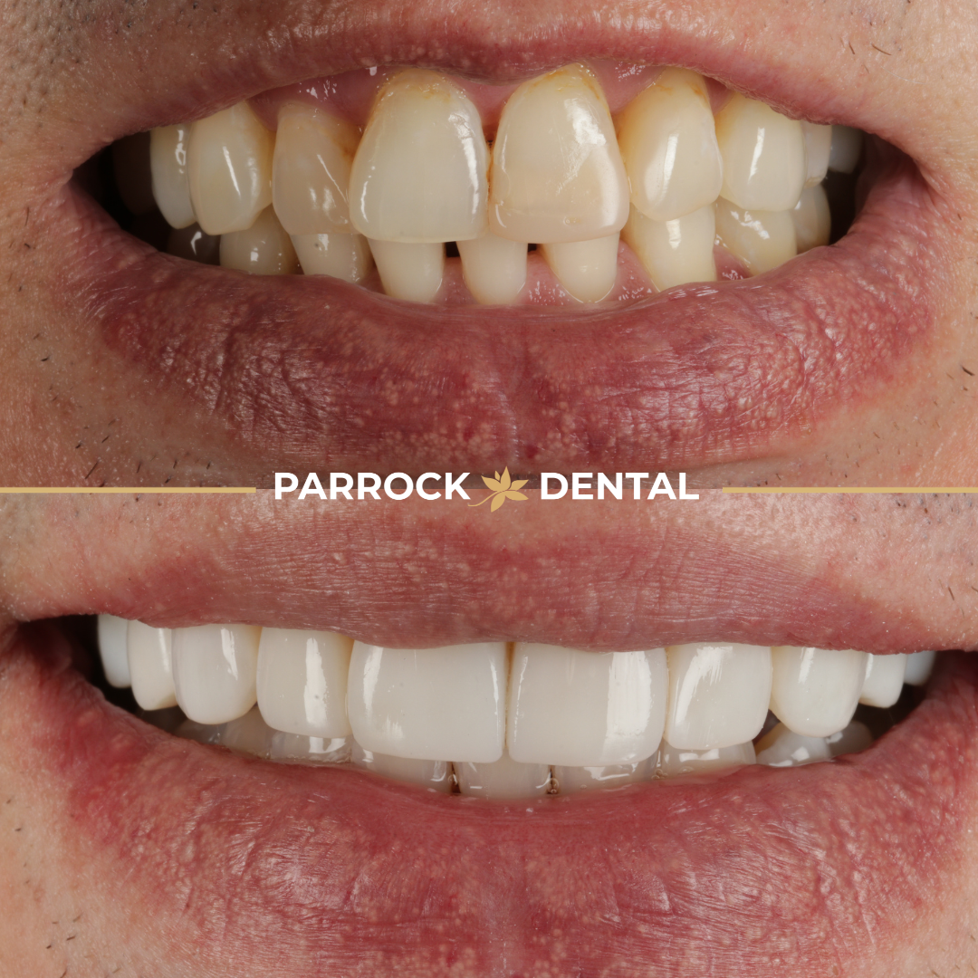 szymon Motwicki - Composite Veneers before after